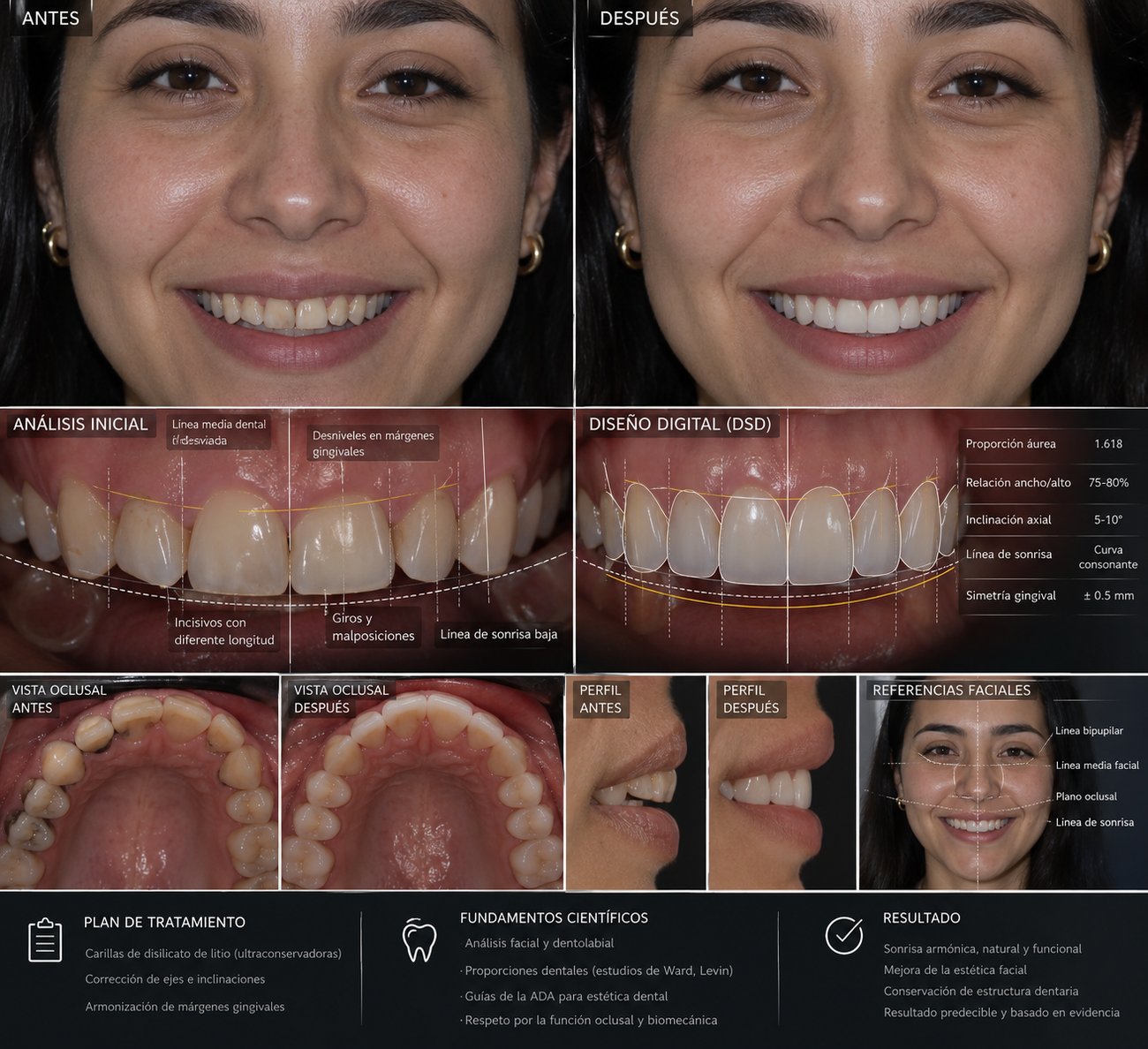 Diseño de sonrisa digital (DSD) en Tlalpan: análisis inicial, diseño digital y resultado