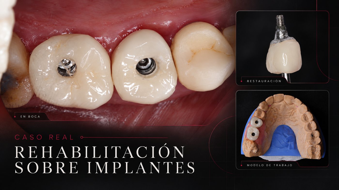 Caso real Dental Advance: coronas atornilladas sobre implantes, restauración y modelo de trabajo