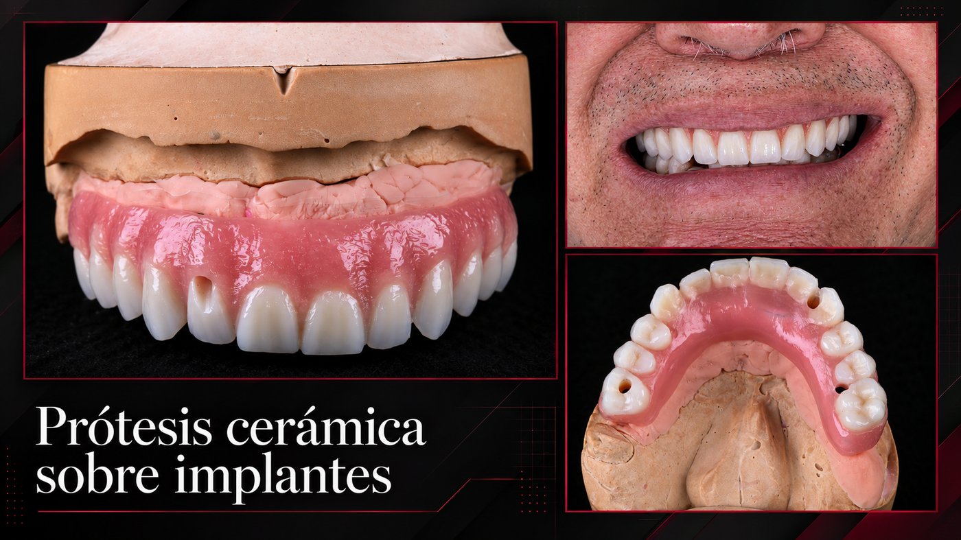 Caso real Dental Advance: prótesis total cerámica sobre implantes, modelo de trabajo y resultado en boca